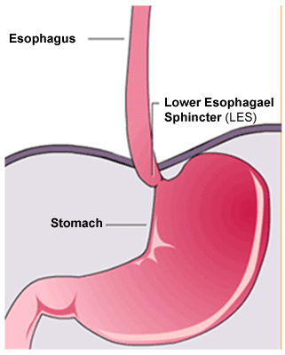 GERD,  gastro-oesophageal reflux disease, medical, GetDoc