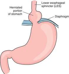 GERD,  gastro-oesophageal reflux disease, medical, GetDoc