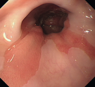 GERD,  gastro-oesophageal reflux disease, medical, GetDoc